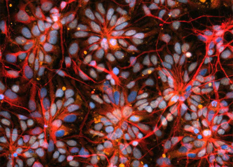 A view of brain organoid cells made of cells from people with Parkinson’s Disease and primary progressive multiple sclerosis.
